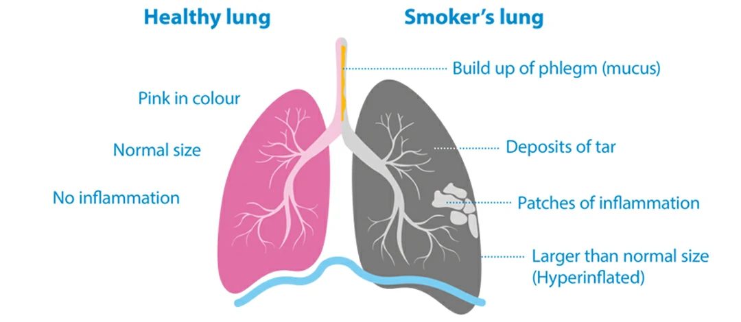 Lung comparison before and after smoking